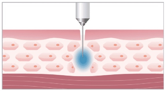 Nadel_Beispiel_Botox_Hyaluron_Filler
