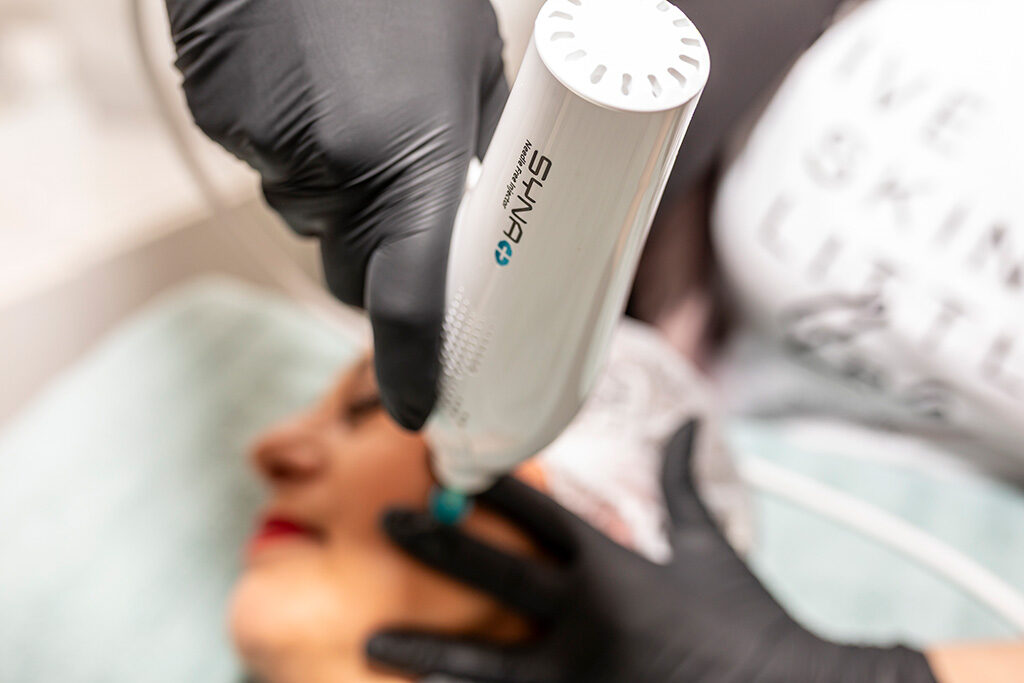 Syna Behandlung statt Botox