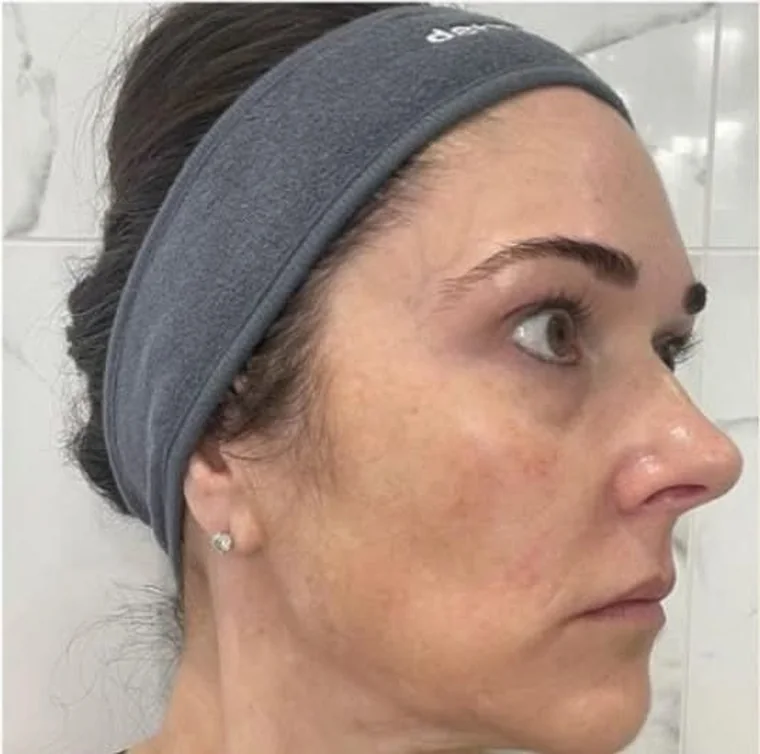 Deutlich gleichmäßigerer Teint nach dem MelanoPro Peel System