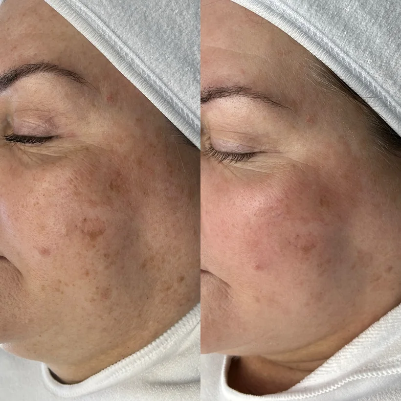 Altersflecken auf Wange und Schläfe vor und nach dem MelanoPro Peel System