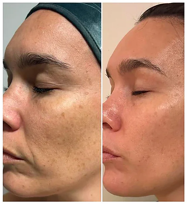 Melasma auf Wange und Schläfe vor und nach dem MelanoPro Peel System