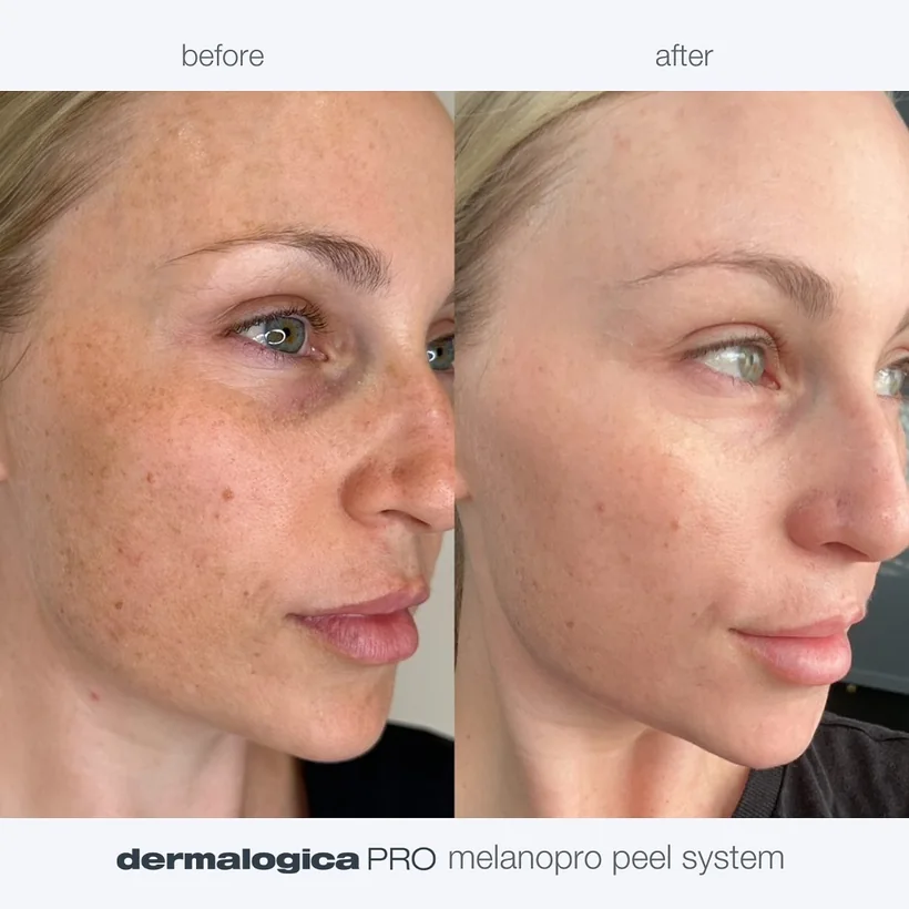 Pigmentflecken und Sommersprossen auf der Wange vor und nach dem MelanoPro Peel System