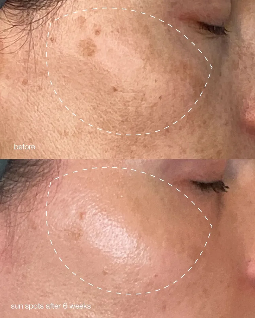 Sonnenflecken auf der Wange vor und sechs Wochen nach dem MelanoPro Peel System