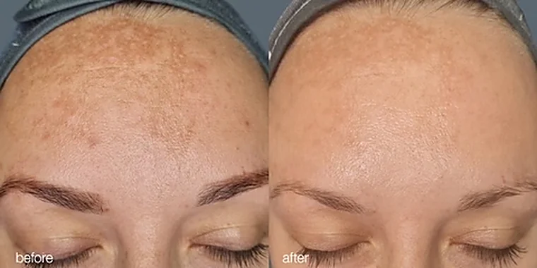 Altersflecken auf der Stirn vor und nach dem MelanoPro Peel System