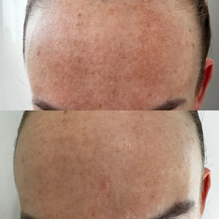 Sonnenflecken auf der Stirn vor und nach dem MelanoPro Peel System